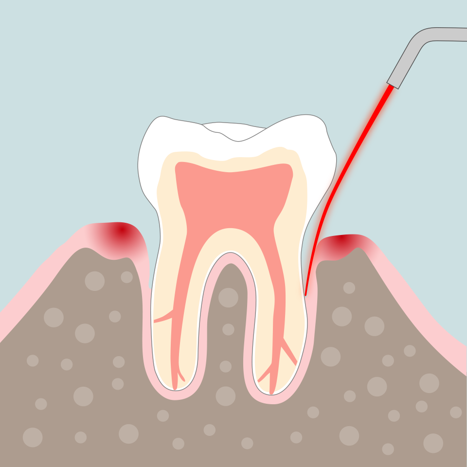 Endodontie Grafik 3