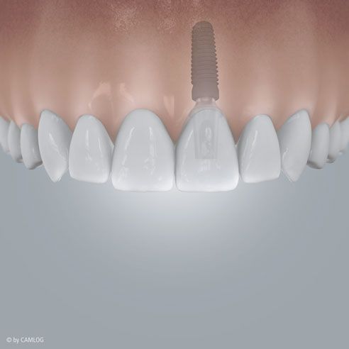 Ersatz eines einzelnen Zahns Grafik 2