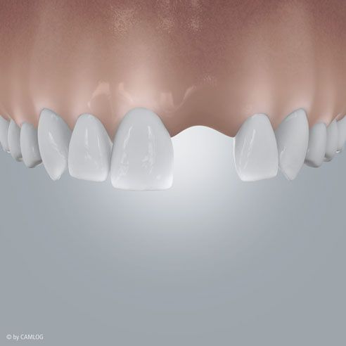 Ersatz eines einzelnen Zahns Grafik 1