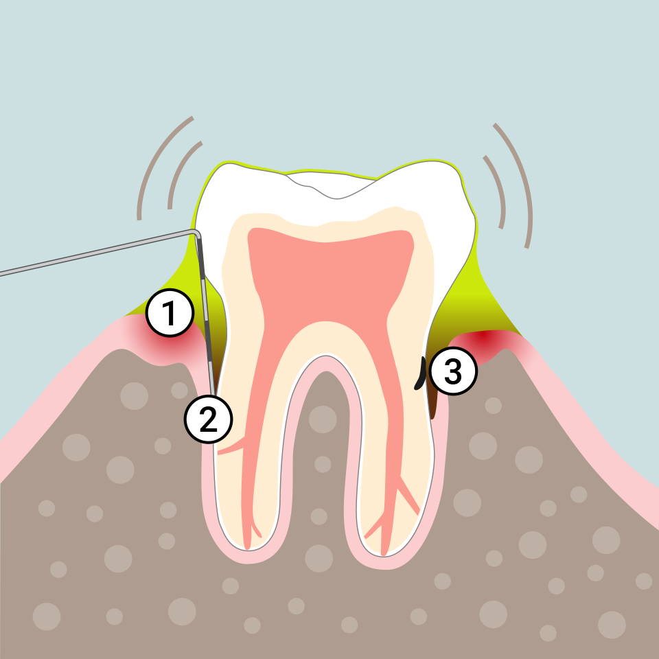 Typische Symptome einer Parodontitis